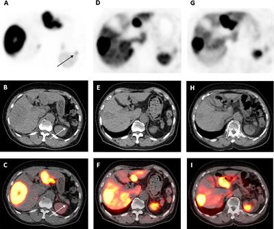 Case Report: Hypoglycemia Due to Metastatic Insulinoma in Insulin-Dependent Type 2 Diabetes Successfully Treated With 177 Lu-DOTATATE